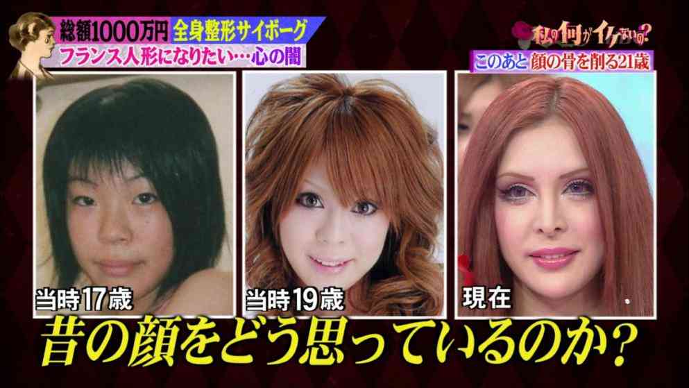 整形タレント・ヴァニラ　プチ整形直後の写真公開【やや閲覧注意】