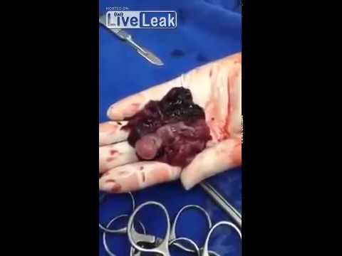 14 Weeks Old Fetus Still Alive and Moving Outside of Uterus  Graphic - YouTube