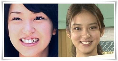 相武紗季や武井咲、板野友美も…八重歯を直したタレントたち