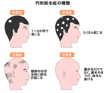 円形脱毛症になったひと