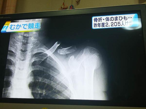 「むかで競走」の骨折事故が多発、体にまひが残るケースも…