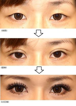 整形をしないできれいな二重を作る方法の2枚目の写真 | マシマロ