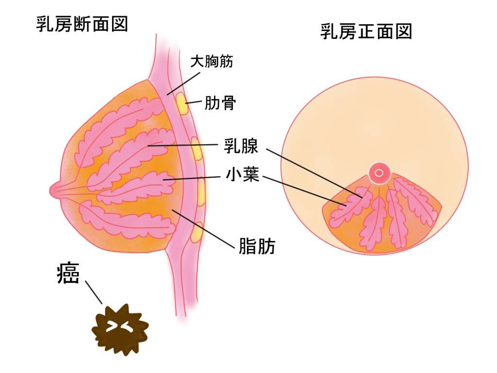 北斗晶さんはマンモグラフィ検診で乳癌に？？  |  健康と病気事典