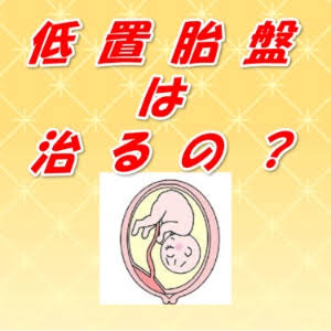 低置胎盤（前置胎盤）で出産された方