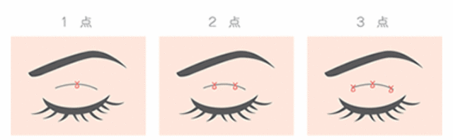整形した方に質問です!(暴露しましたか?)