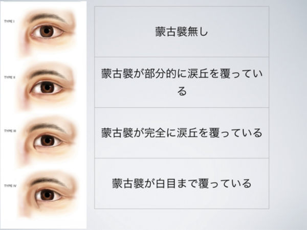 目頭切開していると思う芸能人