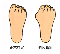 外反母趾の人！