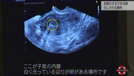 終わりのない不妊治療 - NHK　クローズアップ現代