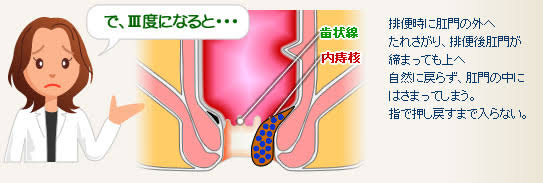 痔の経験者の方