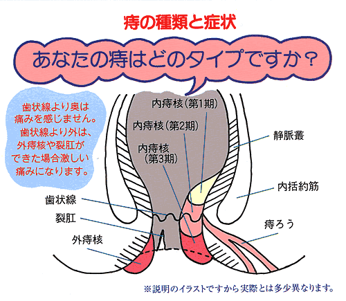 痔の経験者の方