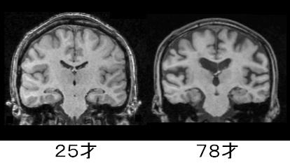 ド忘れ…言葉が出ない!「脳が劣化しやすい人」のNG習慣チェック