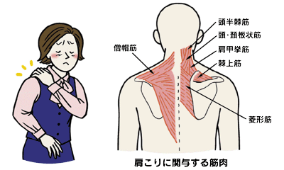 肩こりひどい人