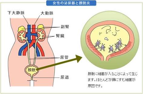 膀胱炎経験者