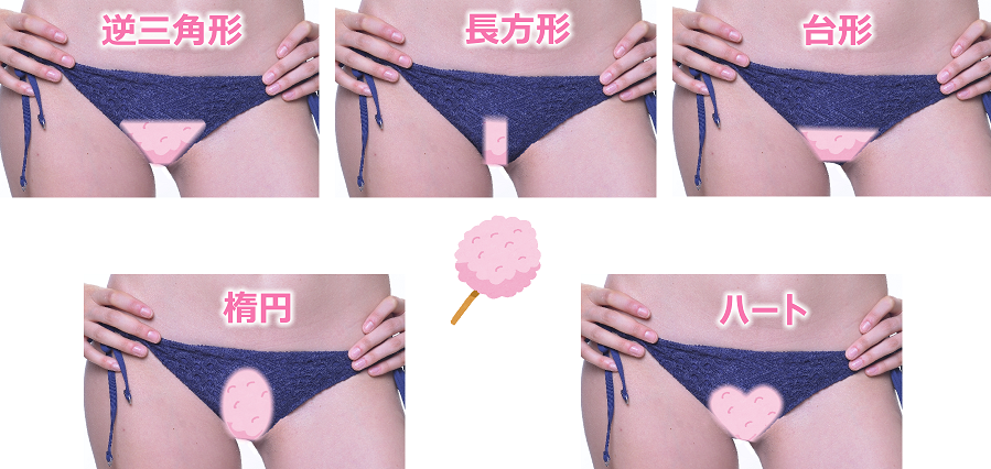 VIOの処理方法