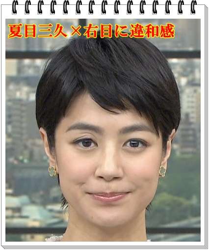 夏目三久アナ まぶたを腫らしたことで噴出した整形疑惑を完全否定