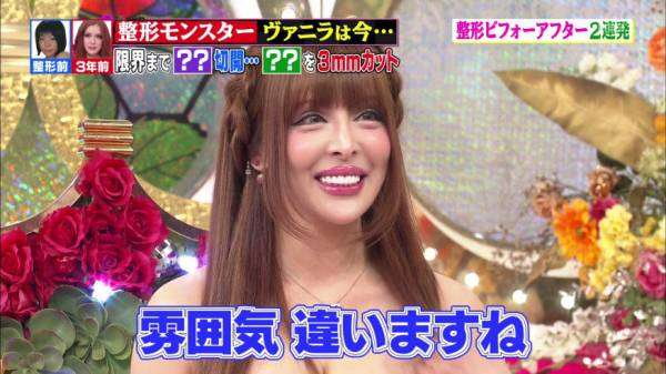 【閲覧注意】整形サイボーグ・ヴァニラがアゴ削りすぎ…？肉体の限界を心配する声