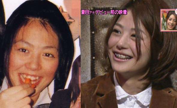 夏目三久アナ まぶたを腫らしたことで噴出した整形疑惑を完全否定