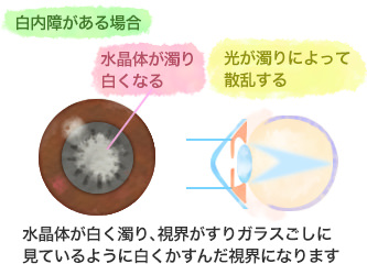 レーシックをした目でも白内障の手術ができるって本当？ | ヘルスケア大学