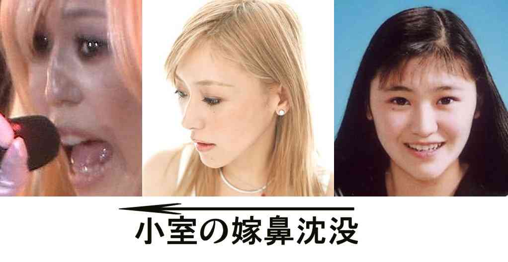 鼻の整形したことある人