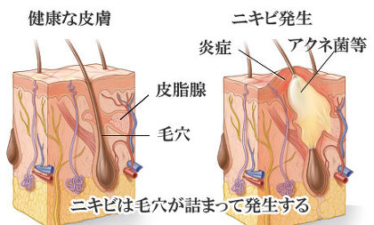 ニキビ治療にかかった費用は？