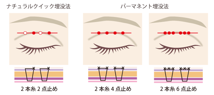 整形の境界線