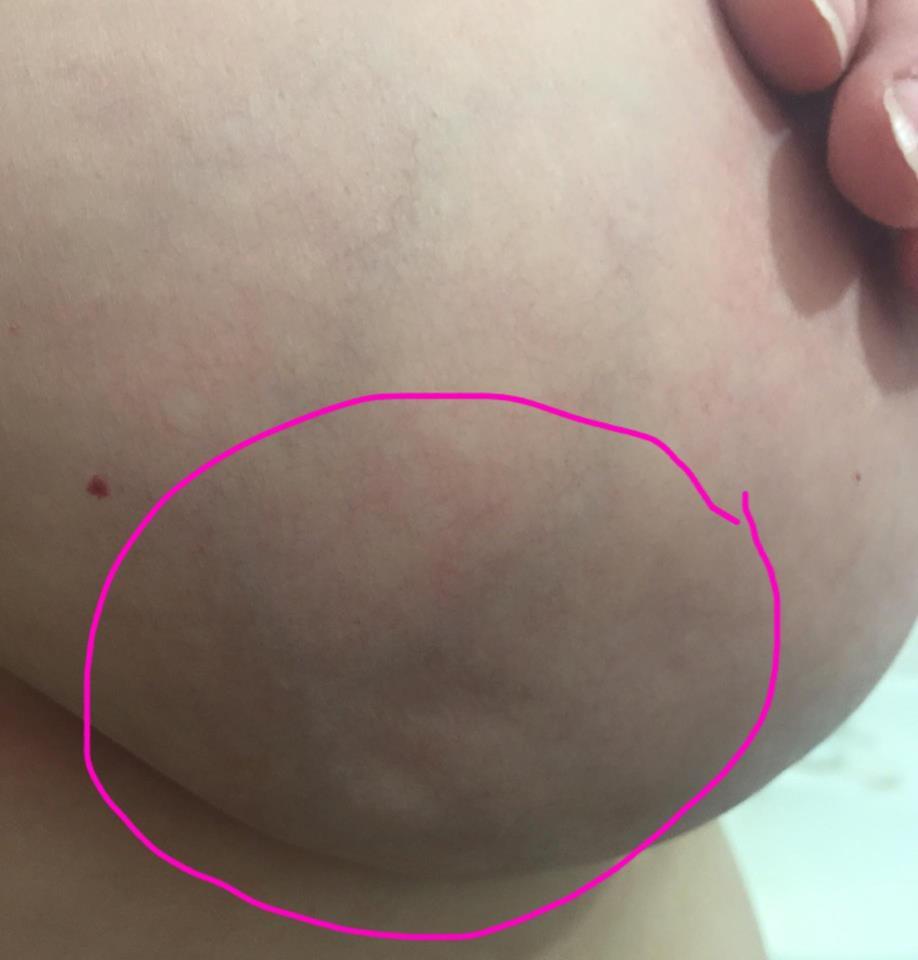 「しこり」だけじゃない。Facebookに驚きの乳がん写真を投稿した女性の思い
