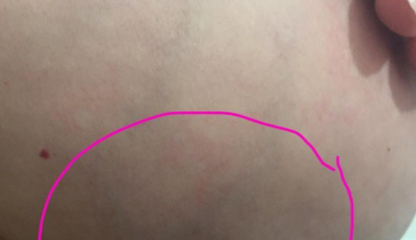 「しこり」だけじゃない。Facebookに驚きの乳がん写真を投稿した女性の思い - Spotlight (スポットライト)