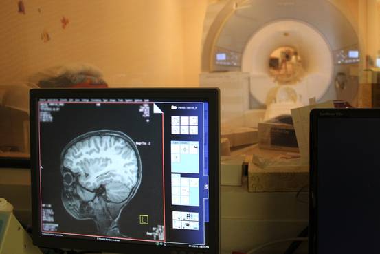       アルツハイマー病、脳の変化は幼少期に　米医学誌 - WSJ    