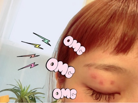 辻希美、揚げ物の最中に油が飛び散り顔を火傷！水ぶくれがつぶれた顔写真アップ