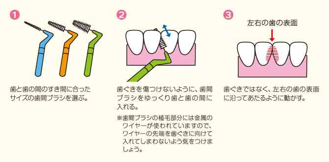 歯のケアについて