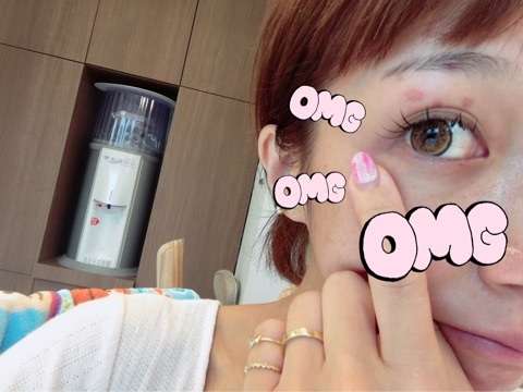 辻希美、揚げ物の最中に油が飛び散り顔を火傷！水ぶくれがつぶれた顔写真アップ