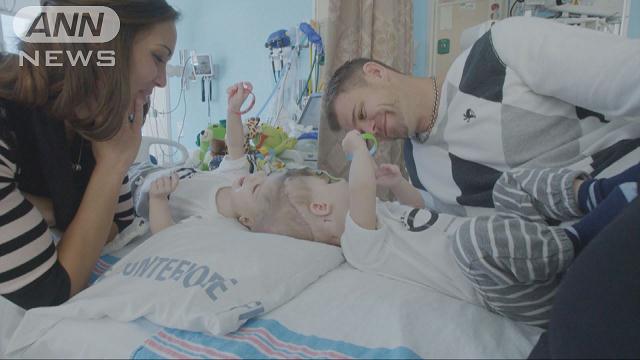 頭部が一つにつながった双子の男の子…NYで分離手術