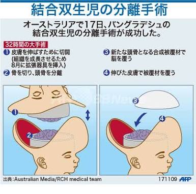頭部が一つにつながった双子の男の子…NYで分離手術