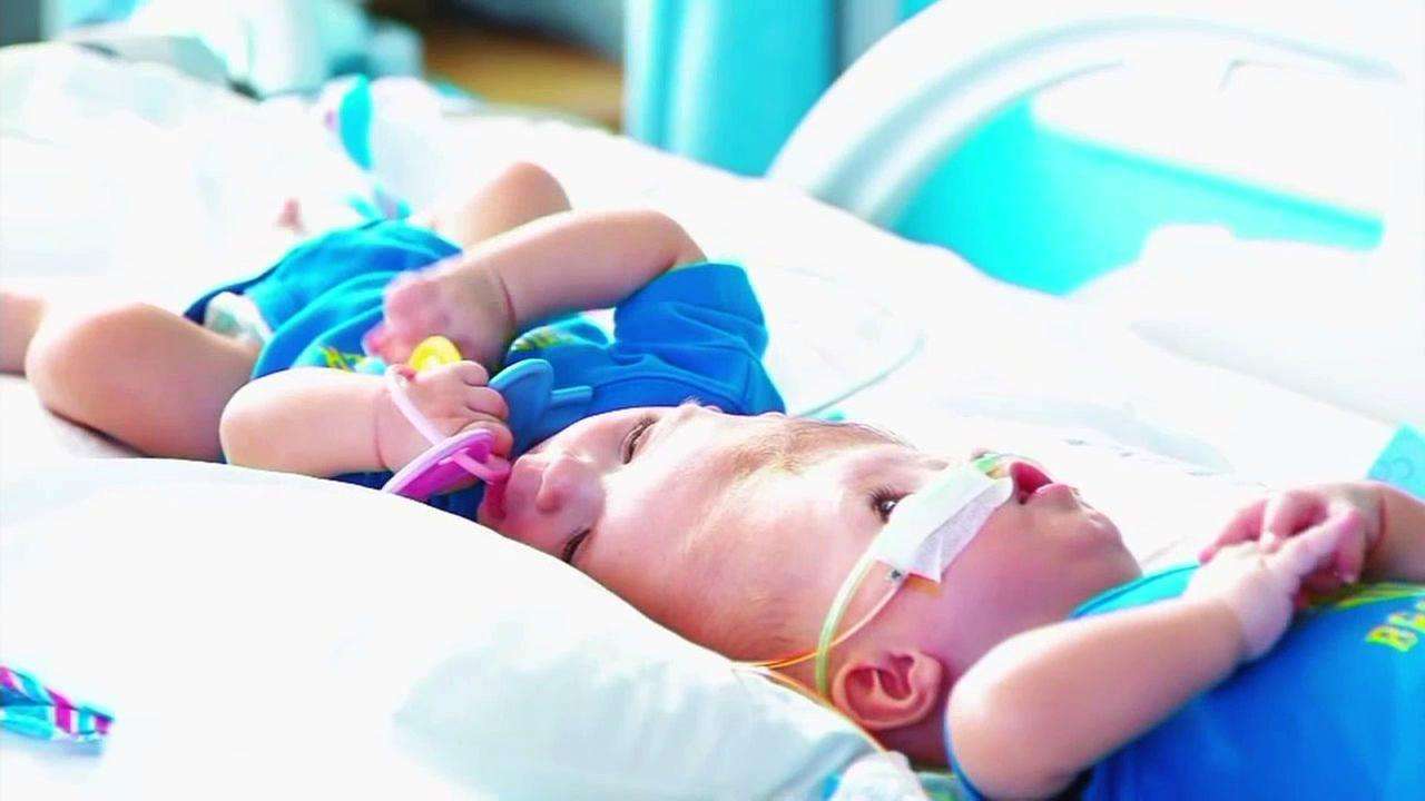New York surgeons finish rare operation to separate conjoined twin boys | abc7ny.com