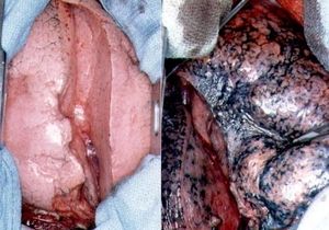大切な人に見せてやれ！煙草吸ってる人の肺。 - NAVER まとめ