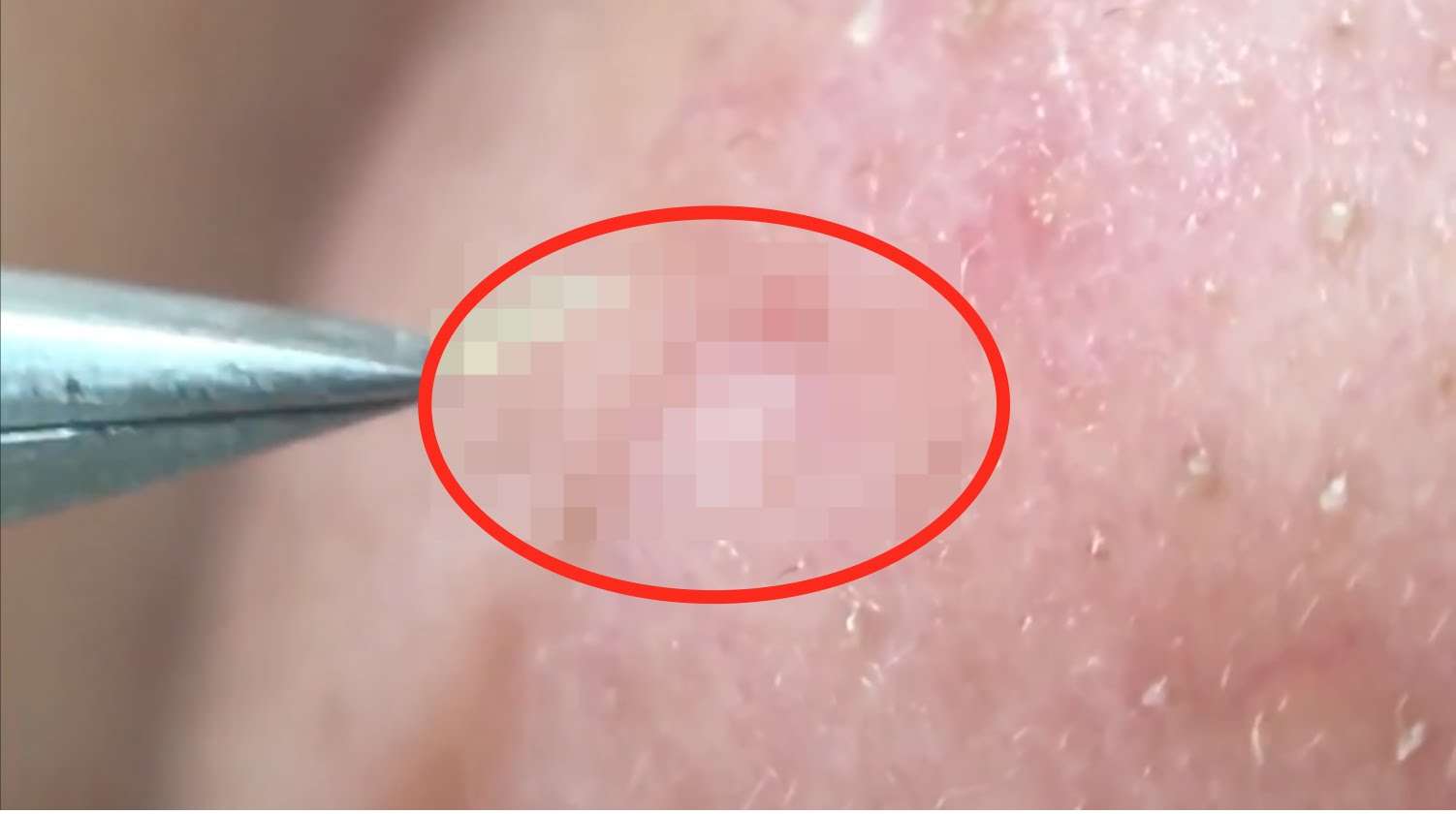 【衝撃】鼻の角栓をきれいに抜きまくる動画
