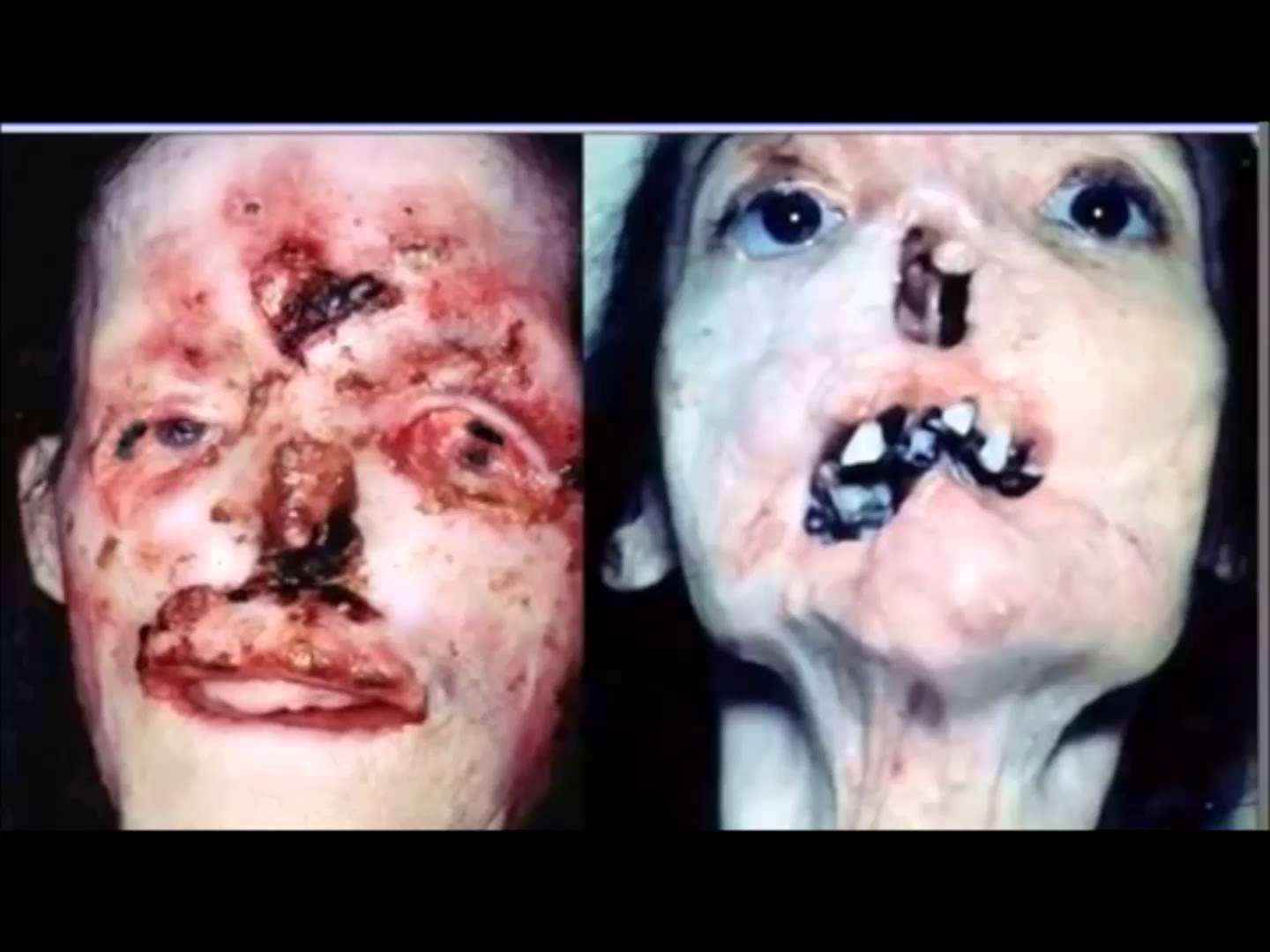 【死】性病末期　のこり僅かの寿命だけだろう････ - YouTube