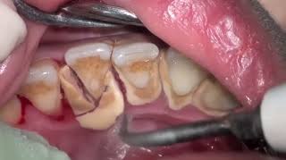 歯石除去したことある方いませんか？