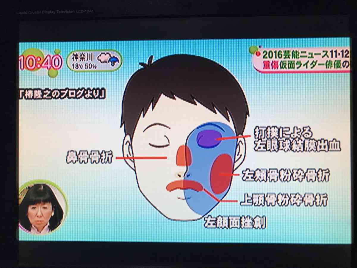 ゴルフクラブで殴られ顔面粉砕骨折の椿隆之、事件後初激白「相手の顔も何も覚えてない」