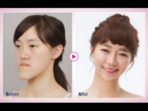 整形が成功する人と失敗する人の違い ガールズちゃんねる Girls Channel