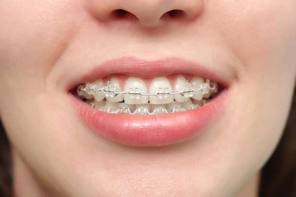 歯列矯正中の方、興味ある方語りましょう‼︎
