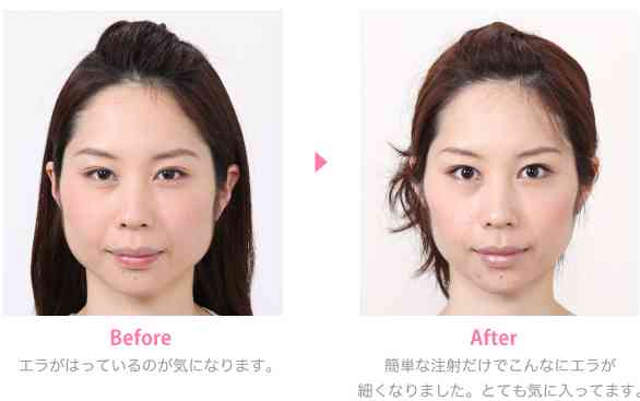 ボトックス注射打ったことありますか ガールズちゃんねる Girls Channel