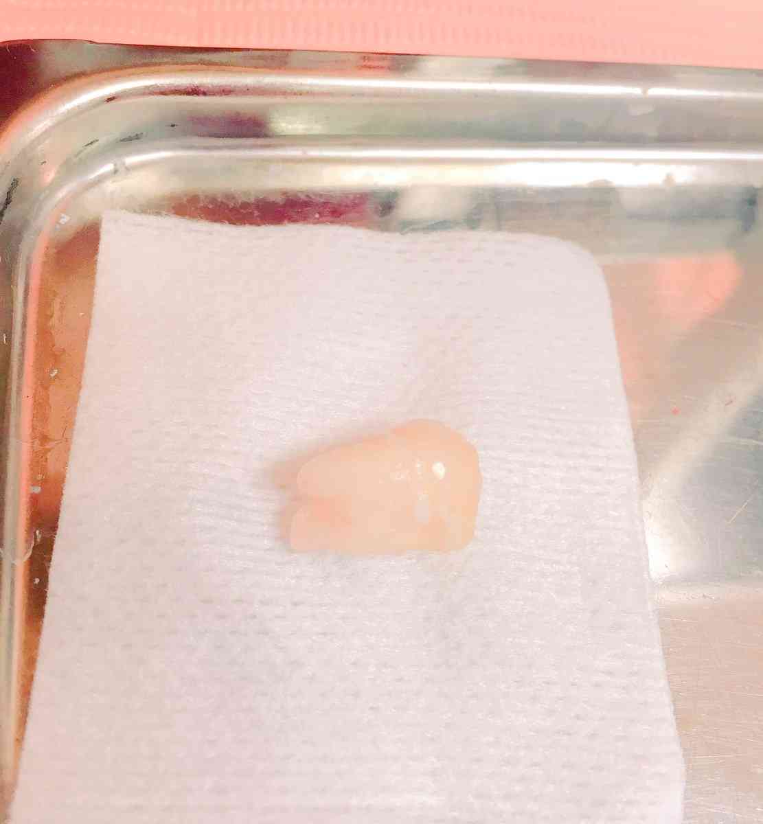 みるきー(渡辺美優紀)、抜歯した「親知らず」写真にコメント殺到「1万円で買う」「宝石みたいだ」