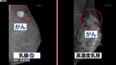 「マンモグラフィで発見できず」乳がん検診変わる？