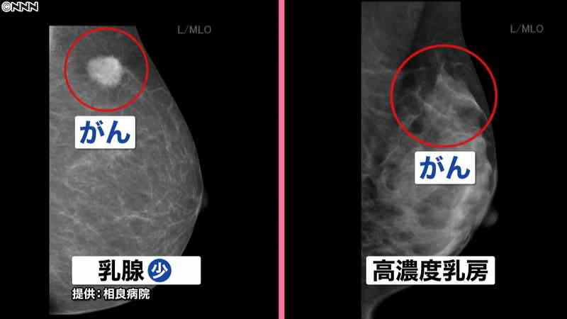 「マンモで発見できず」乳がん検診変わる？(日本テレビ系（NNN）) - Yahoo!ニュース