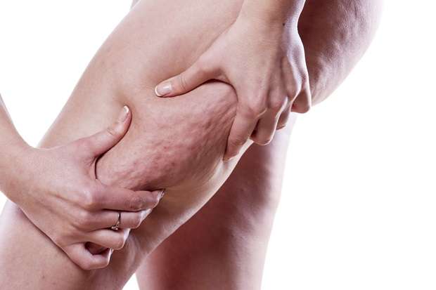 セルライトって何なの？