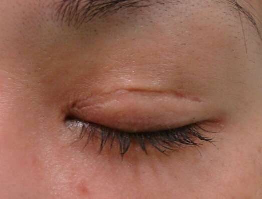 整形した人！  その後バレたりしましたか？