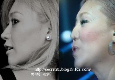 整形した人！  その後バレたりしましたか？