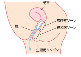 タンポンで死亡した女性がいた！その原因とは？　