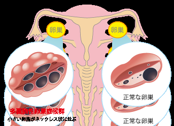 多嚢胞性卵巣症候群（PCOS）の方いらっしゃいますか？